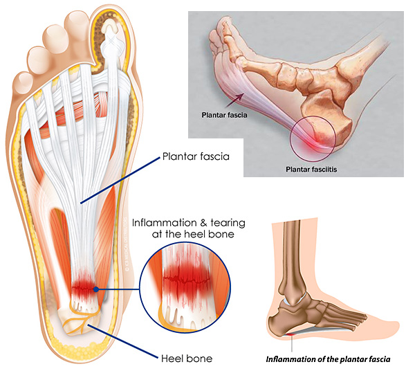 dealing with plantar fasciitis pain