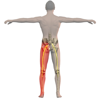 Piriformis Syndrome - Getting Hip Pain Working From Home