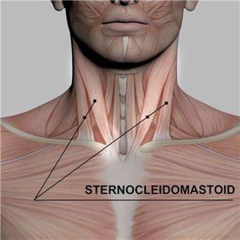 sternocleidomastoid muscle swelling