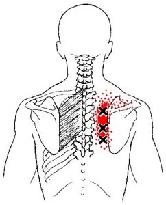 Rhomboids trigger points or “interscapular pain” – Diversified ...