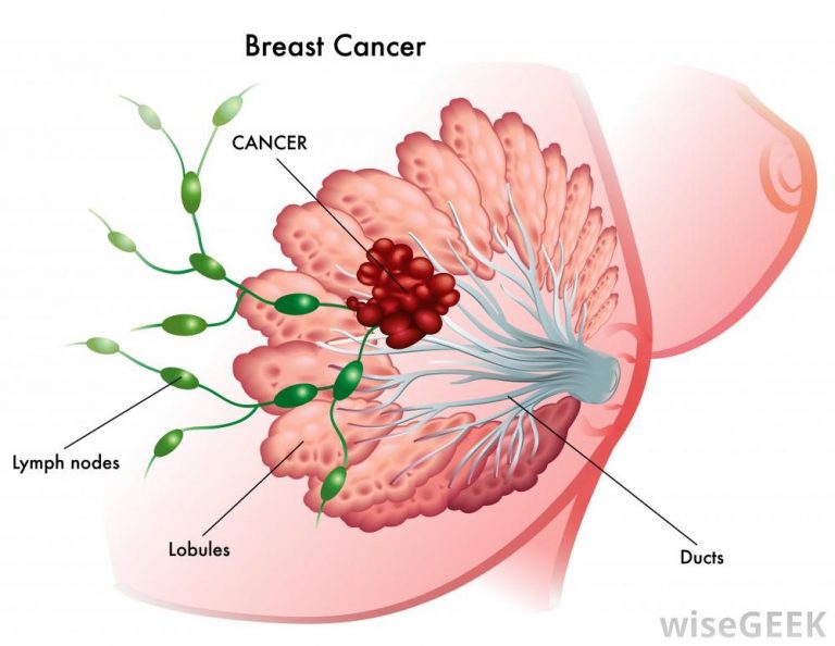 Lymphedema And Breast Cancer Diversified Integrated Sports Clinic 